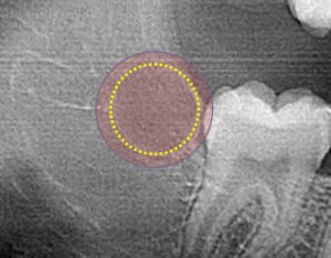 over-ablated tooth bud