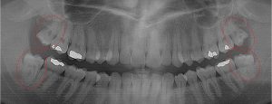 All 4 3rd Molars must be extracted