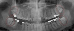 All four 3rd molars need to be extracted immediately