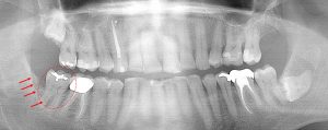 chronic gum infection