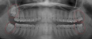 lower left molar & lower right molar require extraction