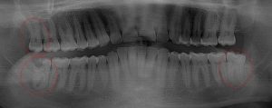 Lower 3rd molars are decayed