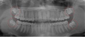 17 year old with probable ectopic eruption