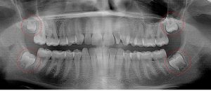 15 year old, likely soft tissue impacted 3rd molars
