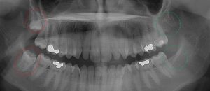 only 2 3rd molars present