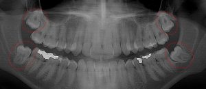 Lower left 3rd molar pushing into the 2nd molar