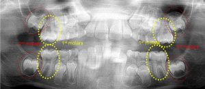 8 Year Old with no 3rd molar tooth buds evident