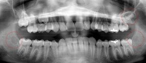 Two lower arch 3rd molar buds with no enamel. Upper left tooth bud has extensive enamel.