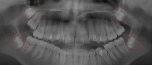 All four molars are present
