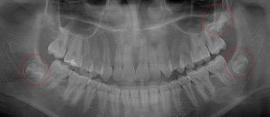 Three 3rd molars in mid-state enamel formation