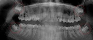 Four 3rd molars with enamel nearly formed.