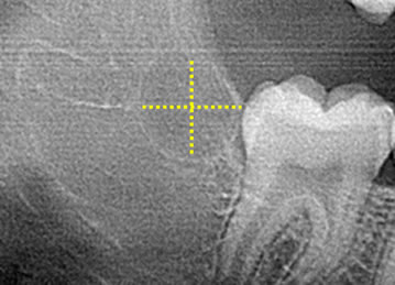Zero3 technology accurately positions the center of the ablation.